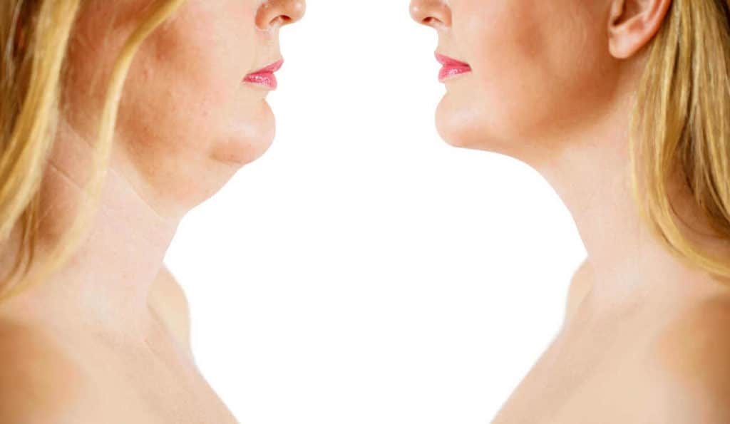Double Chin treatment Kensington Gardens before and after results
