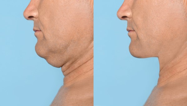 Which Non-Surgical Treatments Work Best for Jowls and Loose Skin Kensington Gardens?