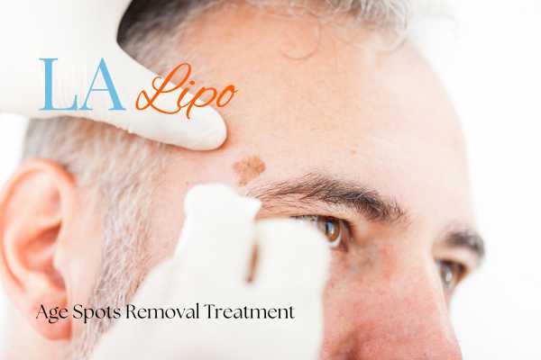 What Are the Most Effective Treatments for Age Spots Kensington Gardens?
