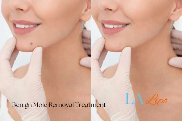 woman's before and after mole removal Kensington Gardens results