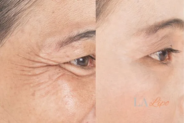 Before and after results of woman - HI-fu wrinkles reduction treatment Kensington Gardens