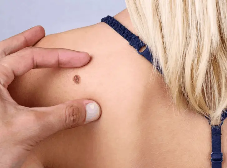 woman having mole removal Kensington Gardens consultation before treatment.