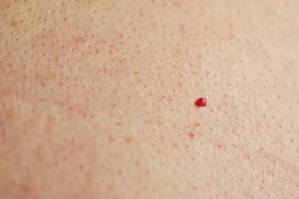 close up of a cherry angioma Kensington Gardens