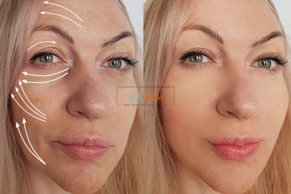 Morpheus 8 results Kensington Gardens face lift.