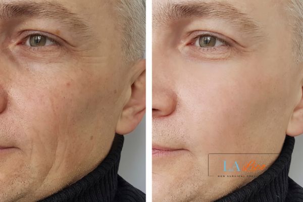 See the amazing results of Morpheus8 Treatment Kensington Gardens!