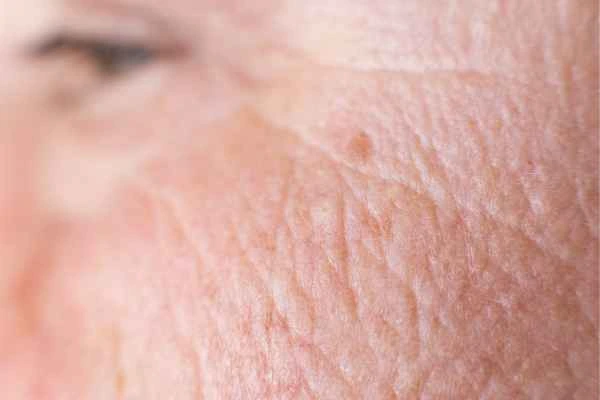 close up picture of a woman's face showing an age spot Kensington Gardens