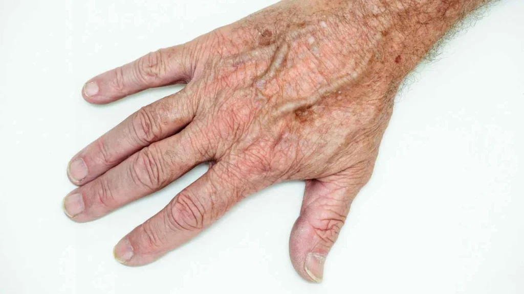 Male hand showing age spot Kensington Gardens