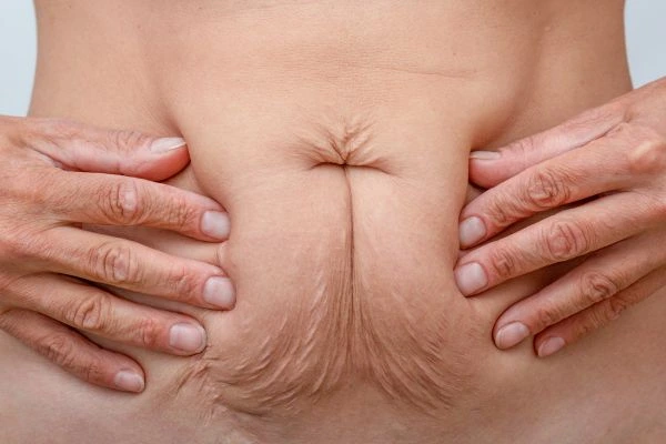 Should I Combine Diastasis Recti Treatment with Body Contouring for Better Results Kensington Gardens?