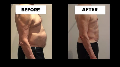 What Symptoms Can Diastasis Recti Cause in Men? Weak Core, Back Pain and Poor Posture Kensington Gardens